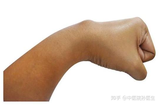 女子腱鞘囊肿的中医治疗，从挤出凝胶状物说起